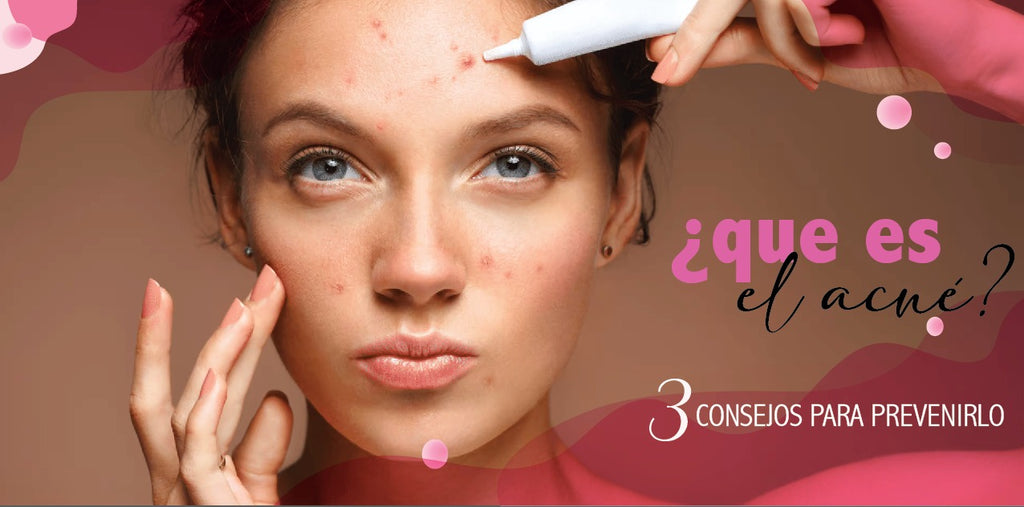 3 consejos para prevenir el acne
